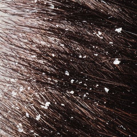 Treating Dandruff with Essential Oils